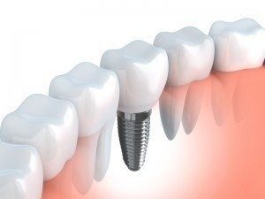 Dental-implants-are-better-carried-out-by-a-member-of-the-American-Academy-of-Implant-Dentistry-and-the-Dental-Implant-Association-300x225